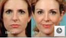facelift botox restylane juvederm houston dallas victoria fort worth